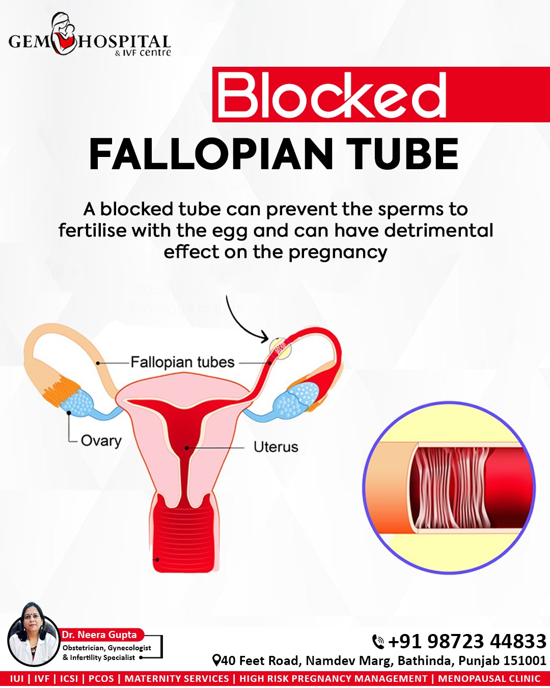 Gem - Blocked Fallopian Tube? A blocked tube can stop sperm from ...