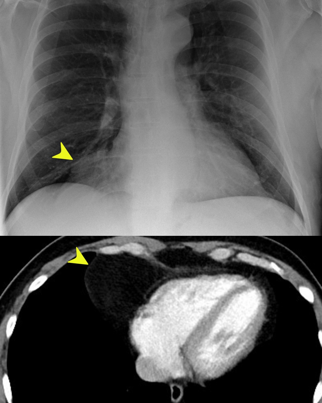 Radiopaedia.org - 🎯 CXR: Rounded opacity obscuring the... | Facebook