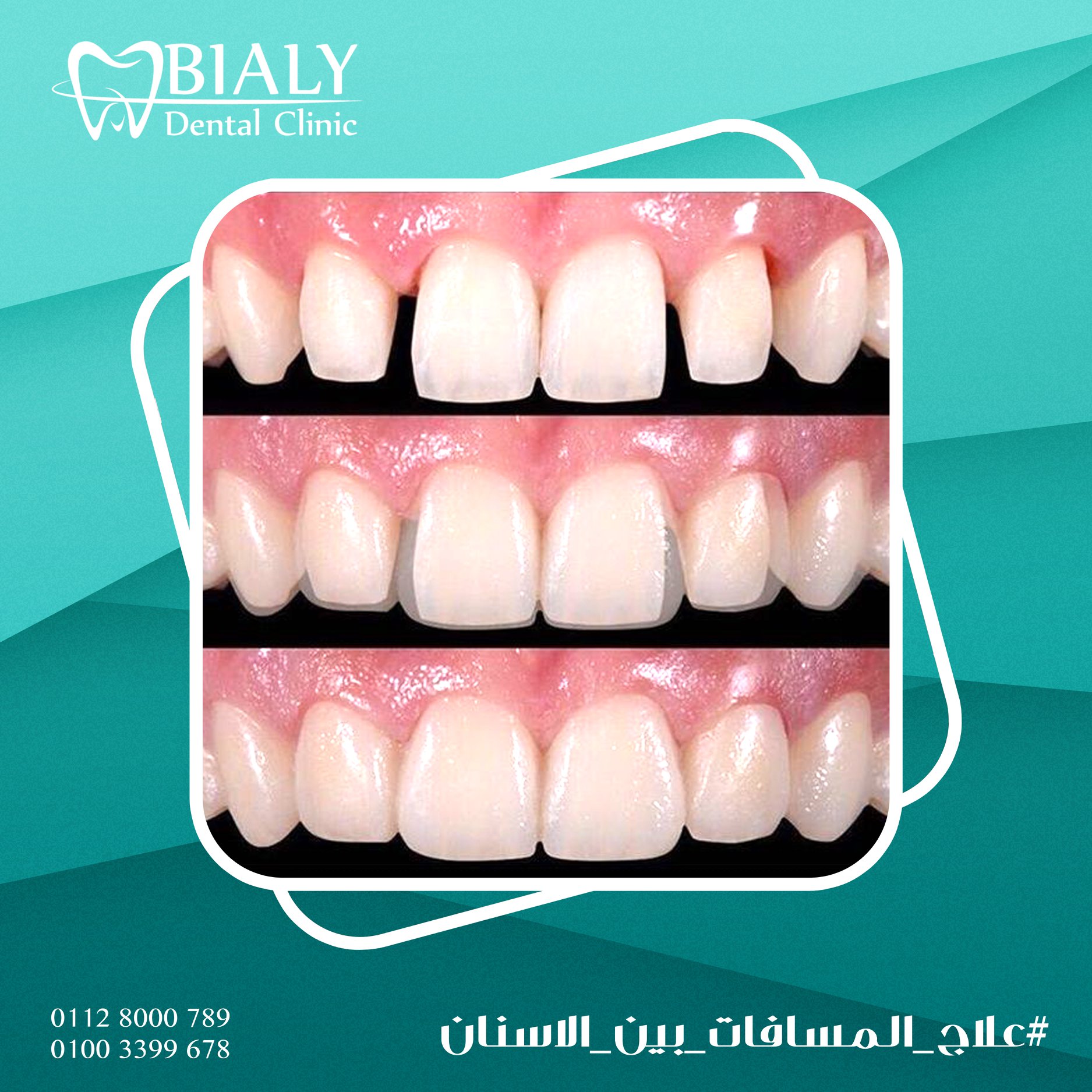 طرق علاج فراغات الأسنان يتوقف علاج Bialy Dental Clinic فيسبوك