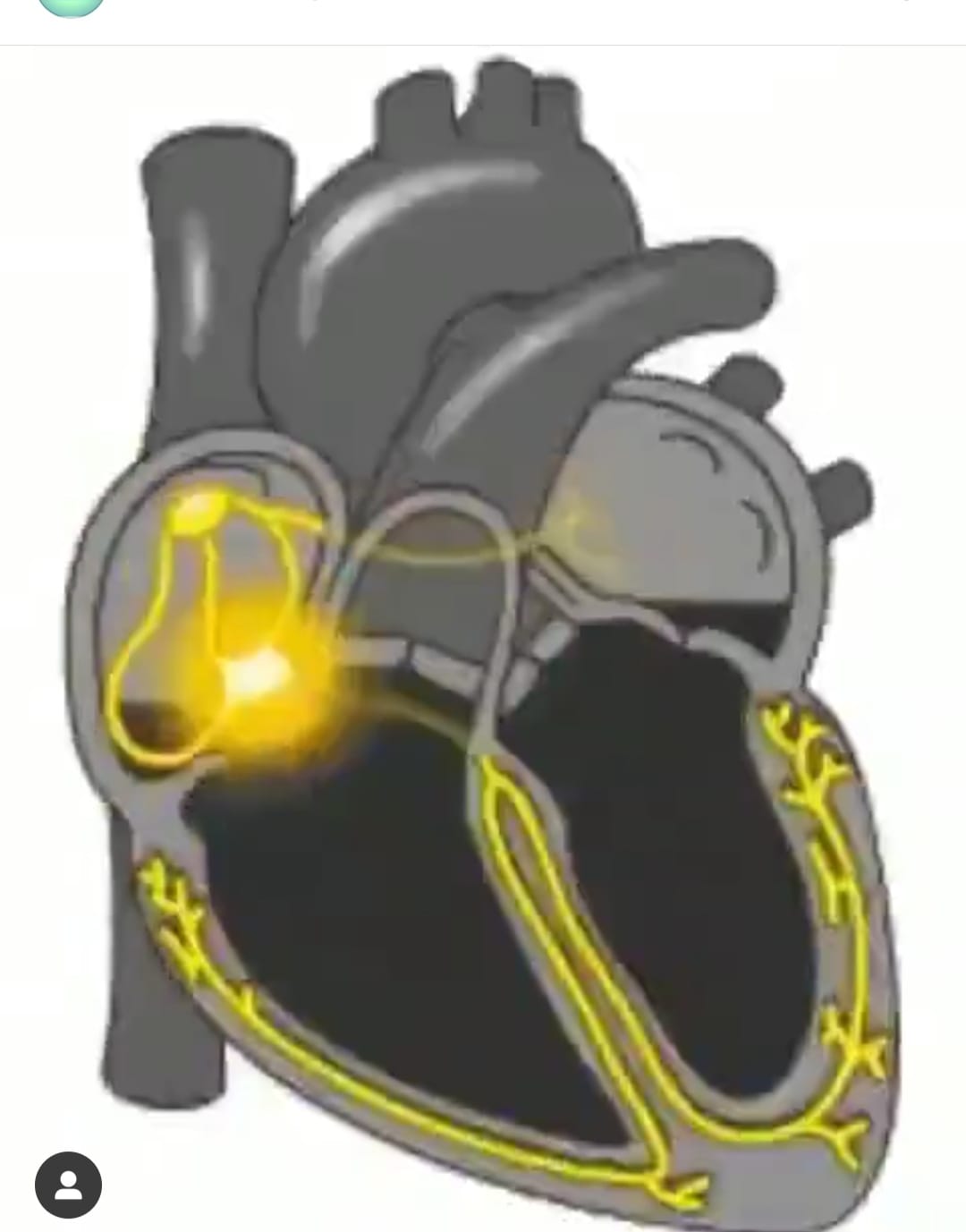 Pharma Rock - How signal pass trough pacemaker to... | Facebook