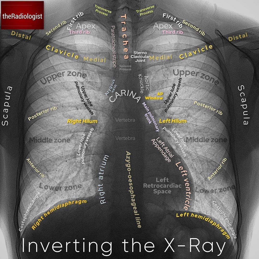 Anatomy of Inverting Chest X Ray - World Of Radiology | Facebook