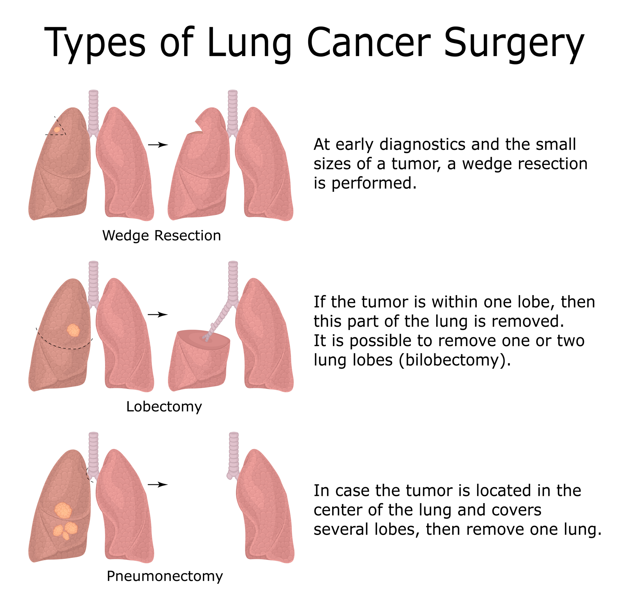 Respiratory - Types of Lung Cancer Surgery 🫁 | Facebook