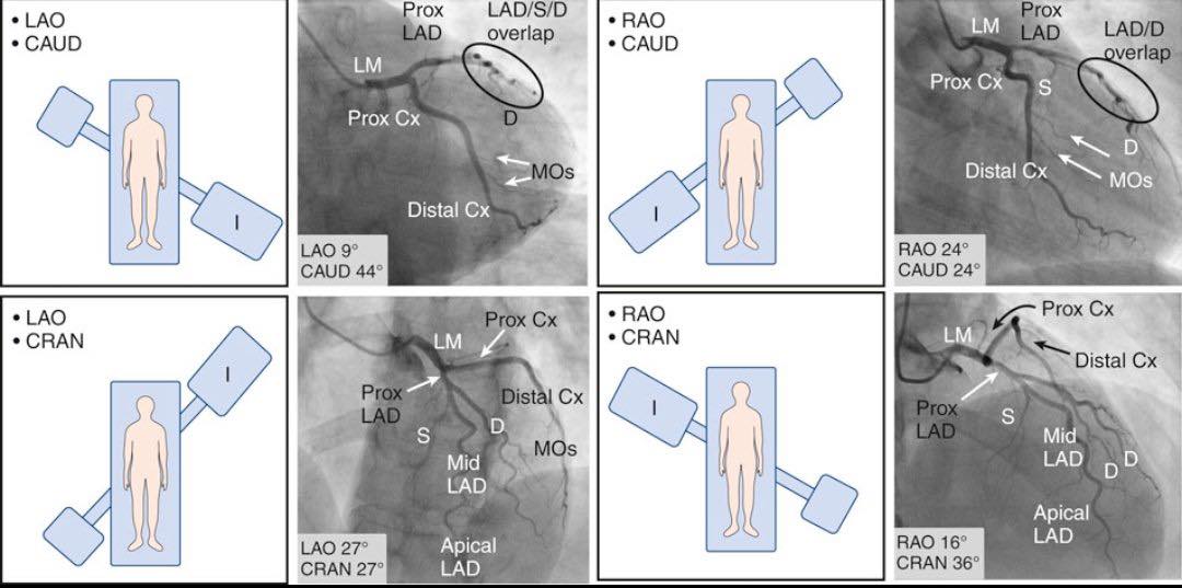 Cardiophilia - Understanding Angiographic Views for Left Coronary ...
