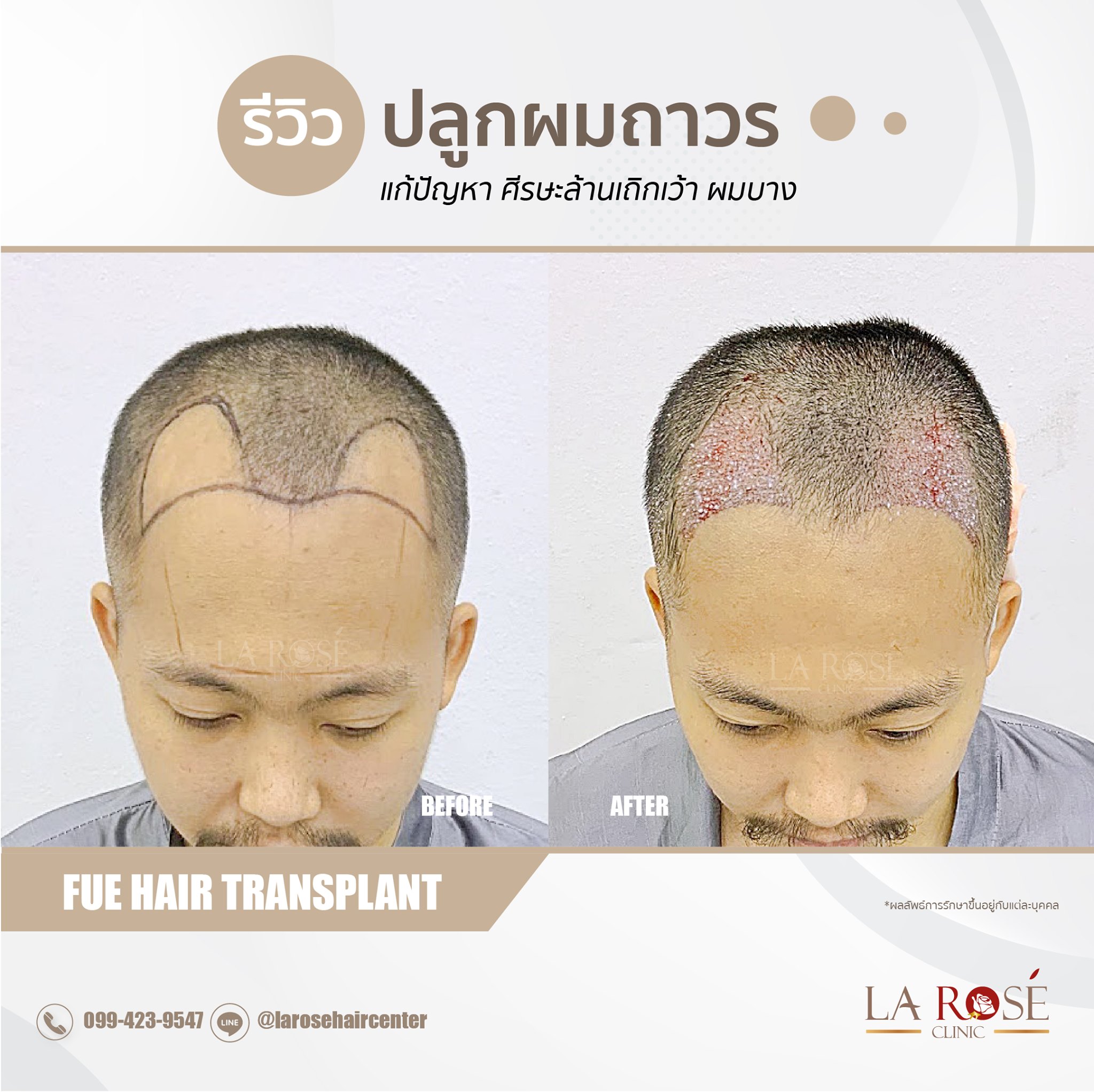 Larose Clinic โปรแกรมปลูกผม FUE Micrograft DHI Longhair | Facebook