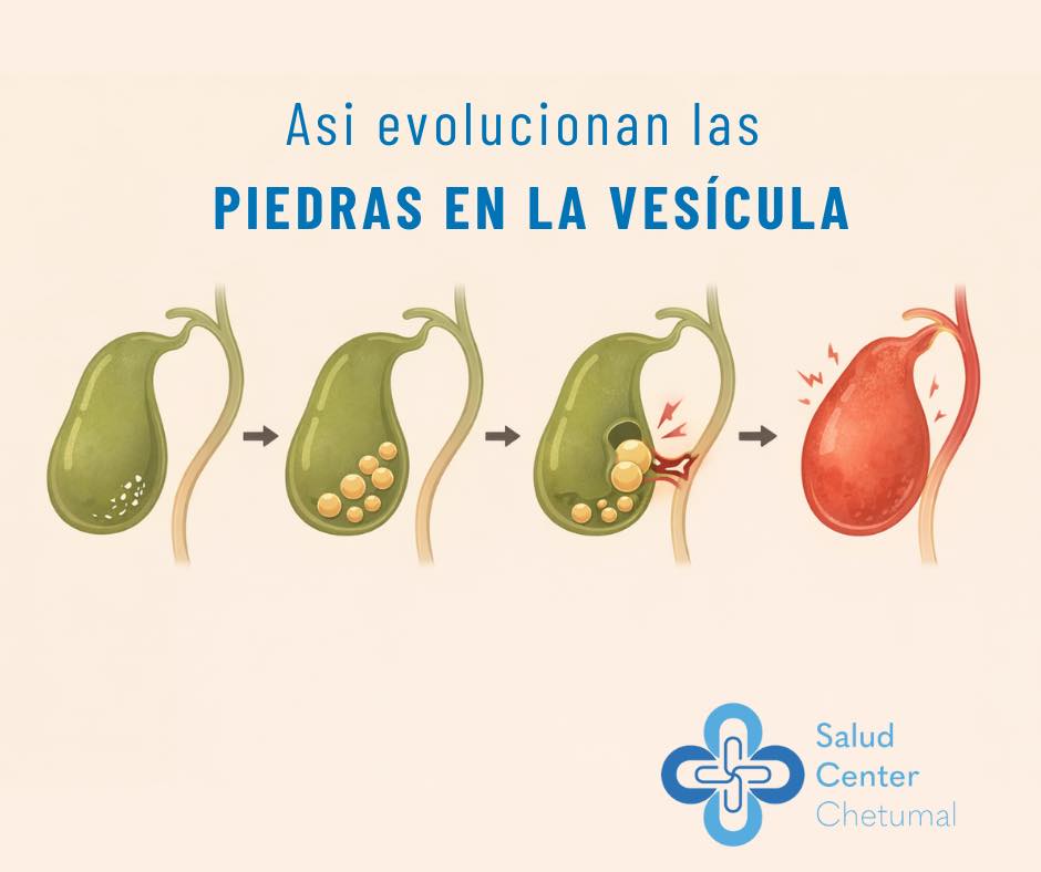 Salud - La evolución de las piedras en la vesícula: lo que debes saber ...