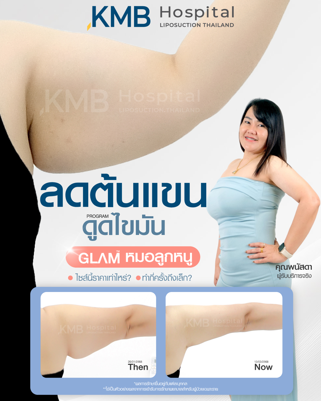 KMB - 𝙐𝙥𝙙𝙖𝙩𝙚 🥰 ผลลัพธ์ โปรแกรม #ดูดไขมันต้นแขน ʀᴇᴠɪᴇᴡ จากเคสจริง ที่ ...