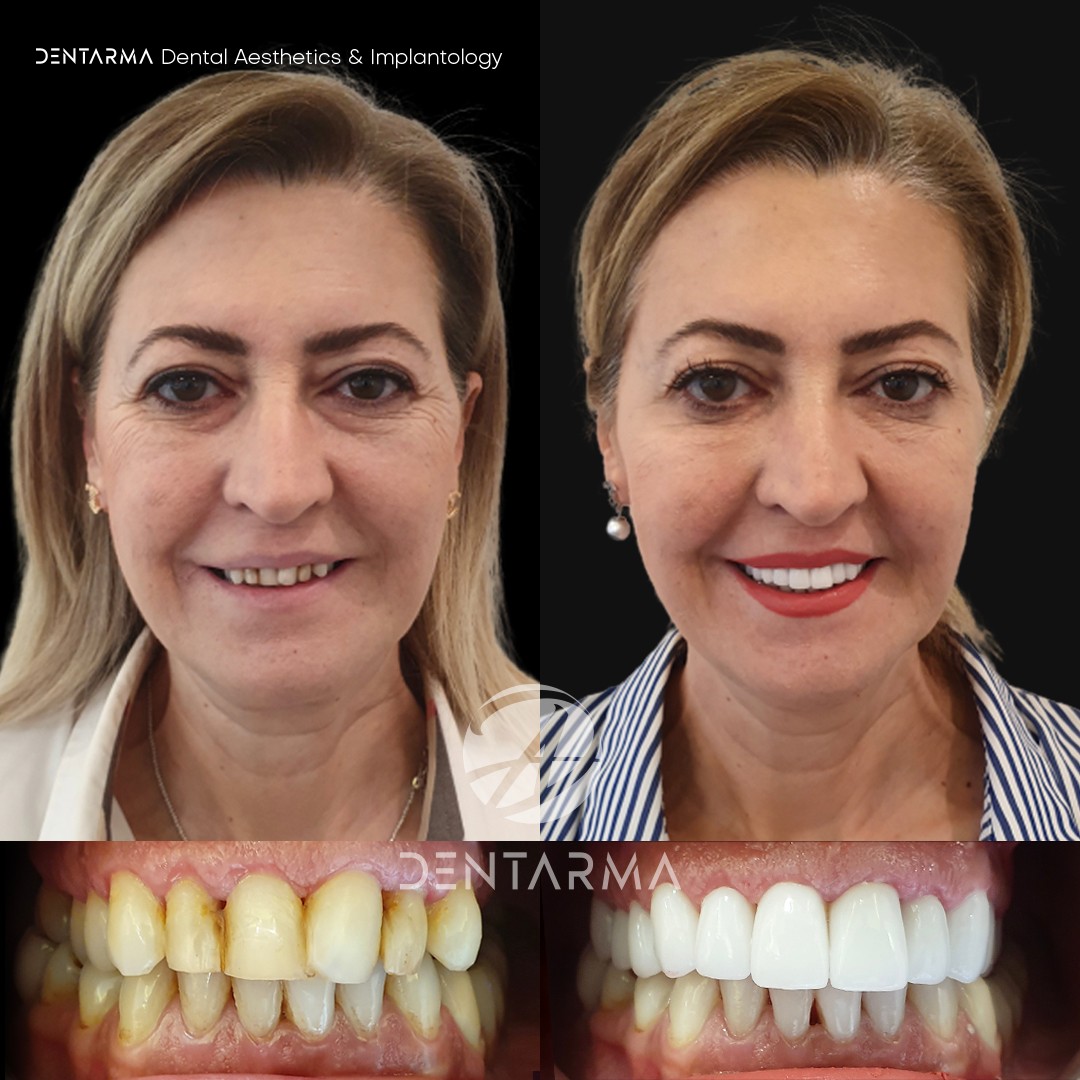 The color and strength of the tooth structure may change over time ...