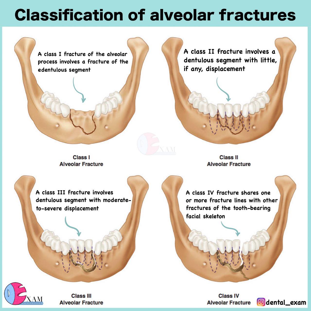 Dental - Classification of alveolar fracture | Facebook