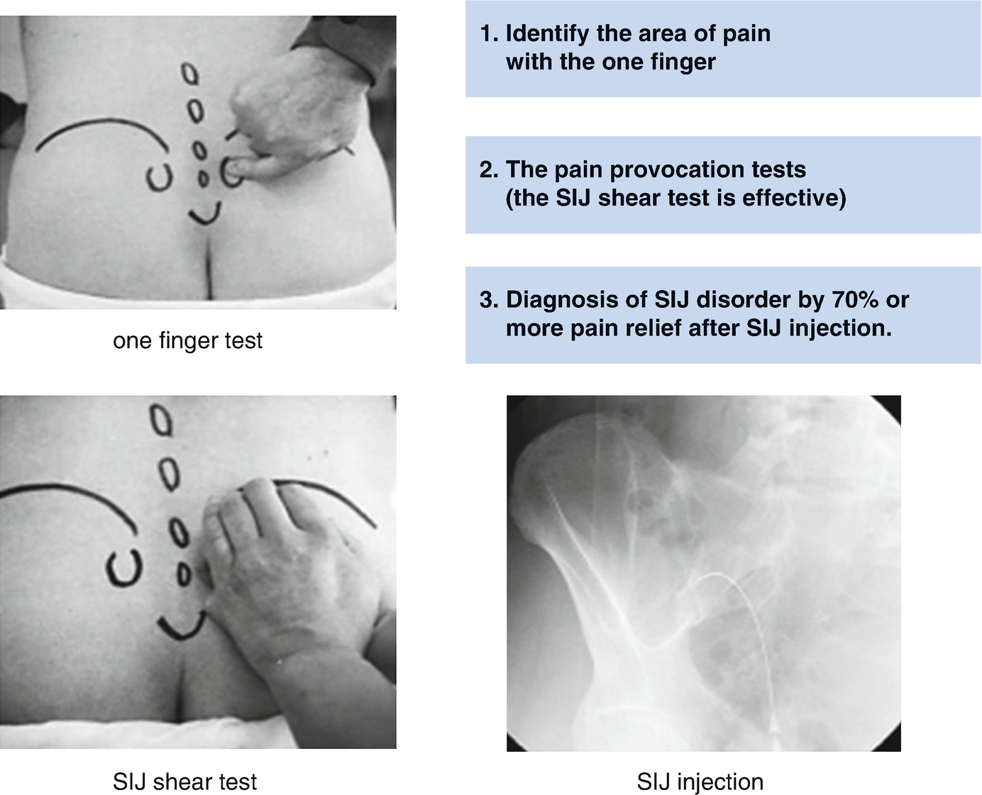 MSK - Sacroiliac joint dysfunction is overdiagnosed. It is not common ...