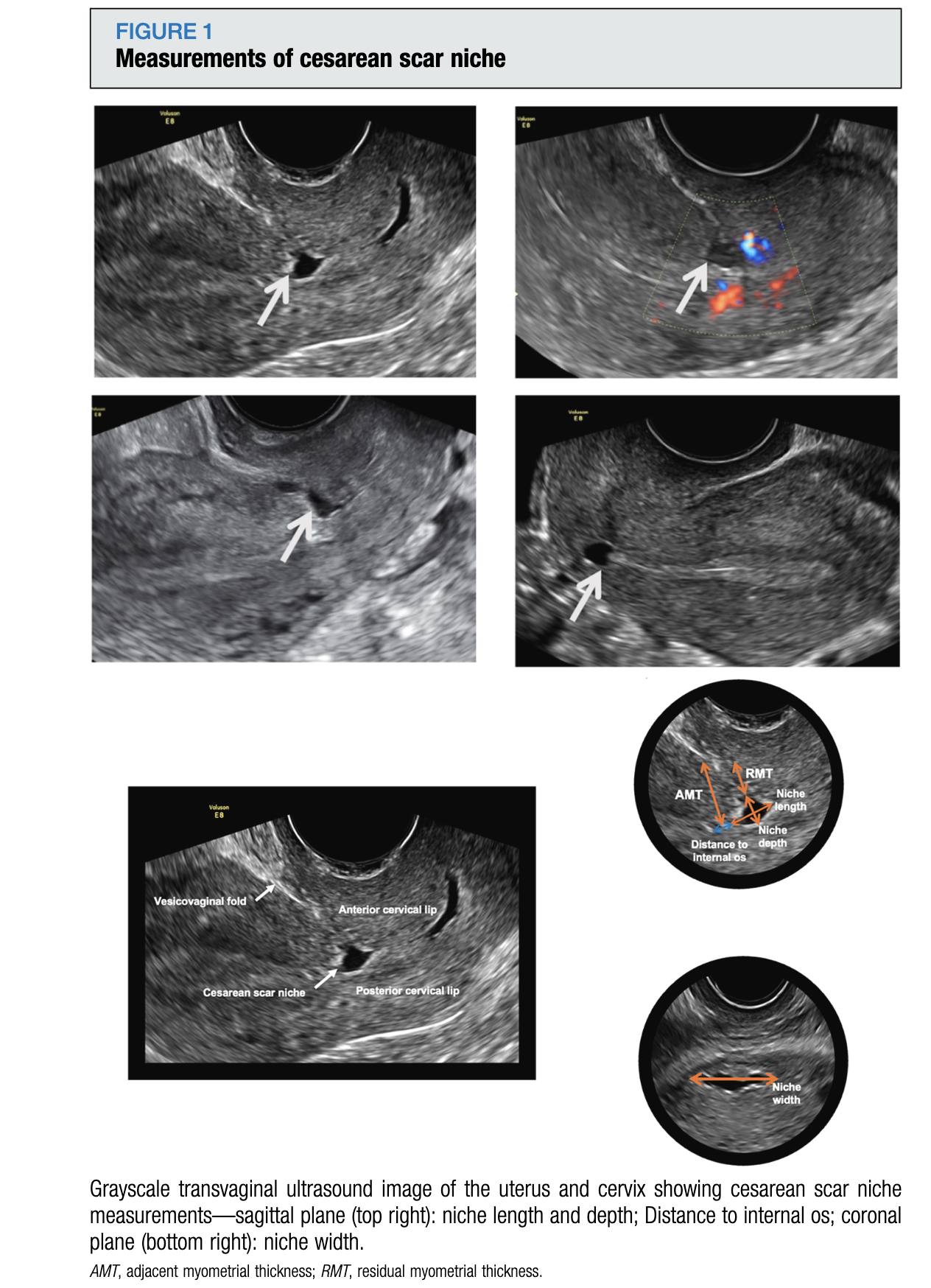 Postnatal healing of cesarean scar: an ultrasound study https://ow.ly/RTtx50XXSZI
