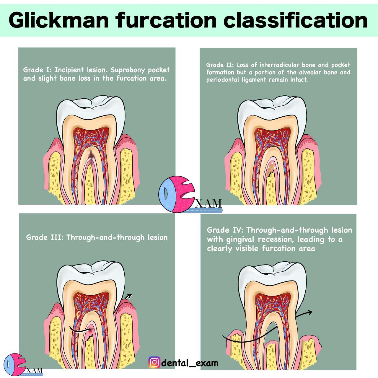 Dental - Glickman furcation classification | Facebook