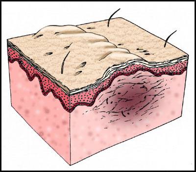 Internal scar tissue... - Brook Seminars Bodywork Education | Facebook