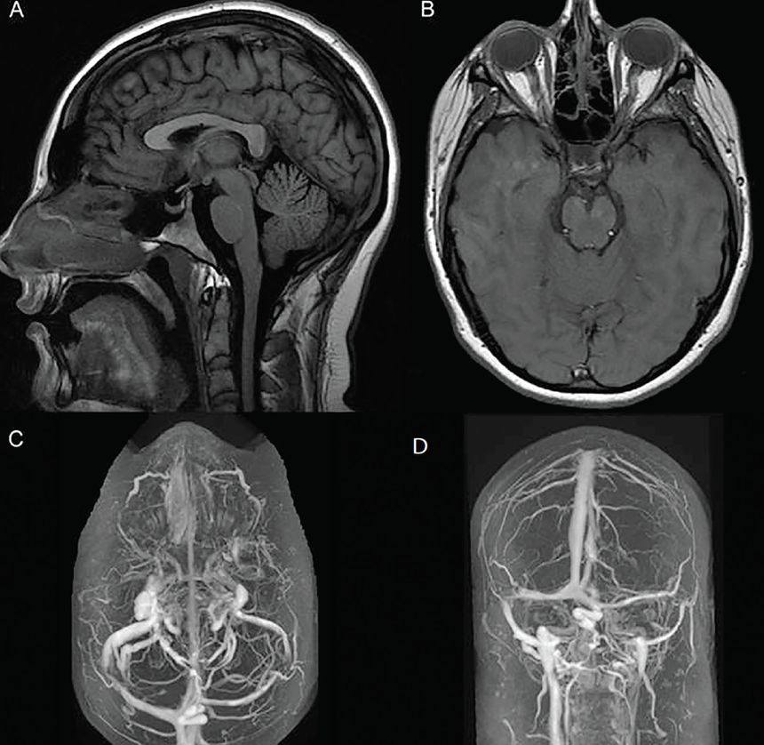 Ophthalmology-Notes And Synopses - Spring Catarrh: Photo credit: on ...