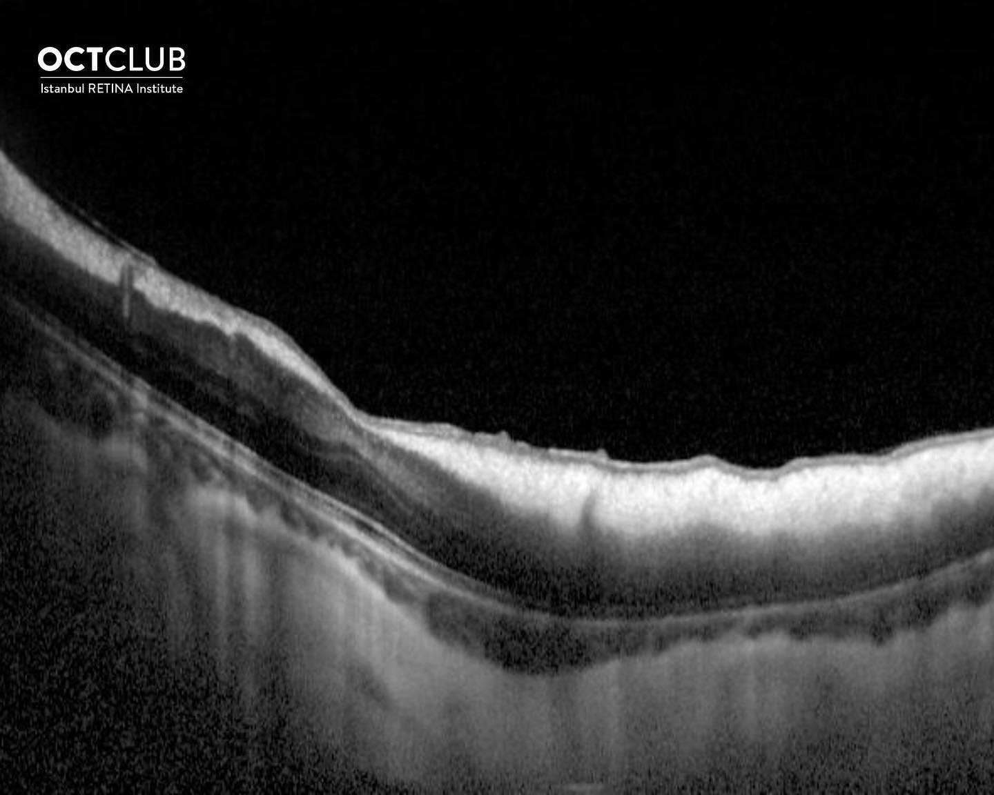 OCT Club - Myelinated nerve fibers in a 14-year old girl... | Facebook