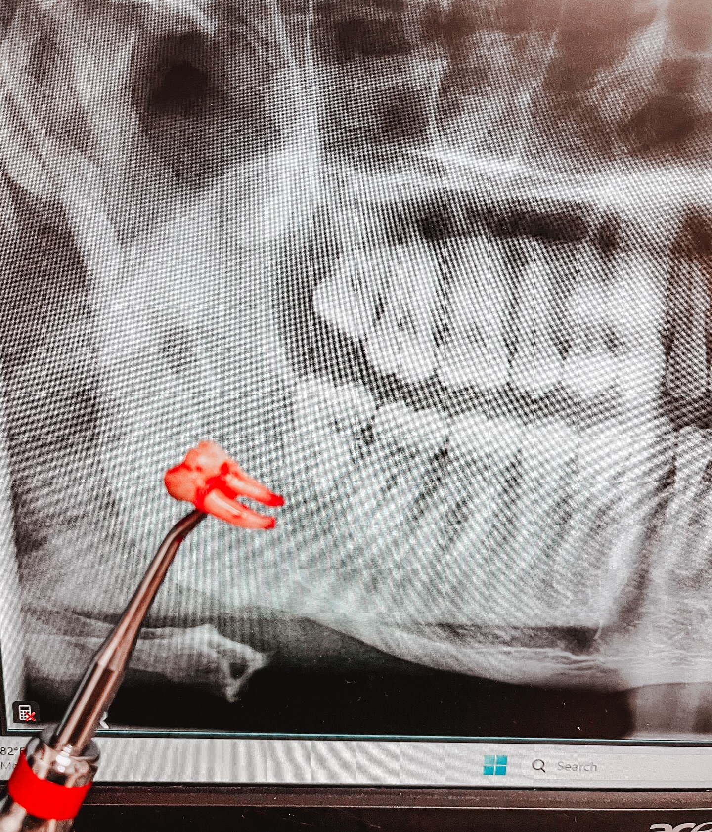 Dr. - Tooth on a stick for the win! Extraction #32 Envelope FTMPF with ...
