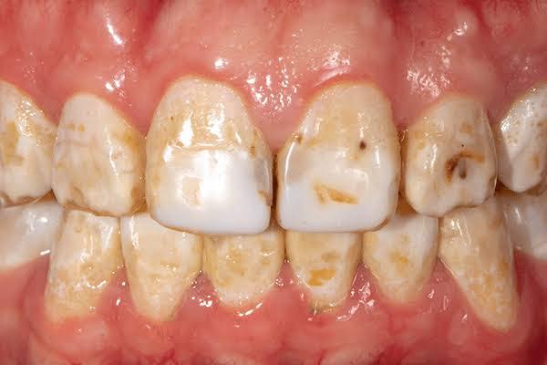 Doc - “Bakit hindi pantay pantay kulay ng ngipin mo” FLUOROSIS Ito ay ...