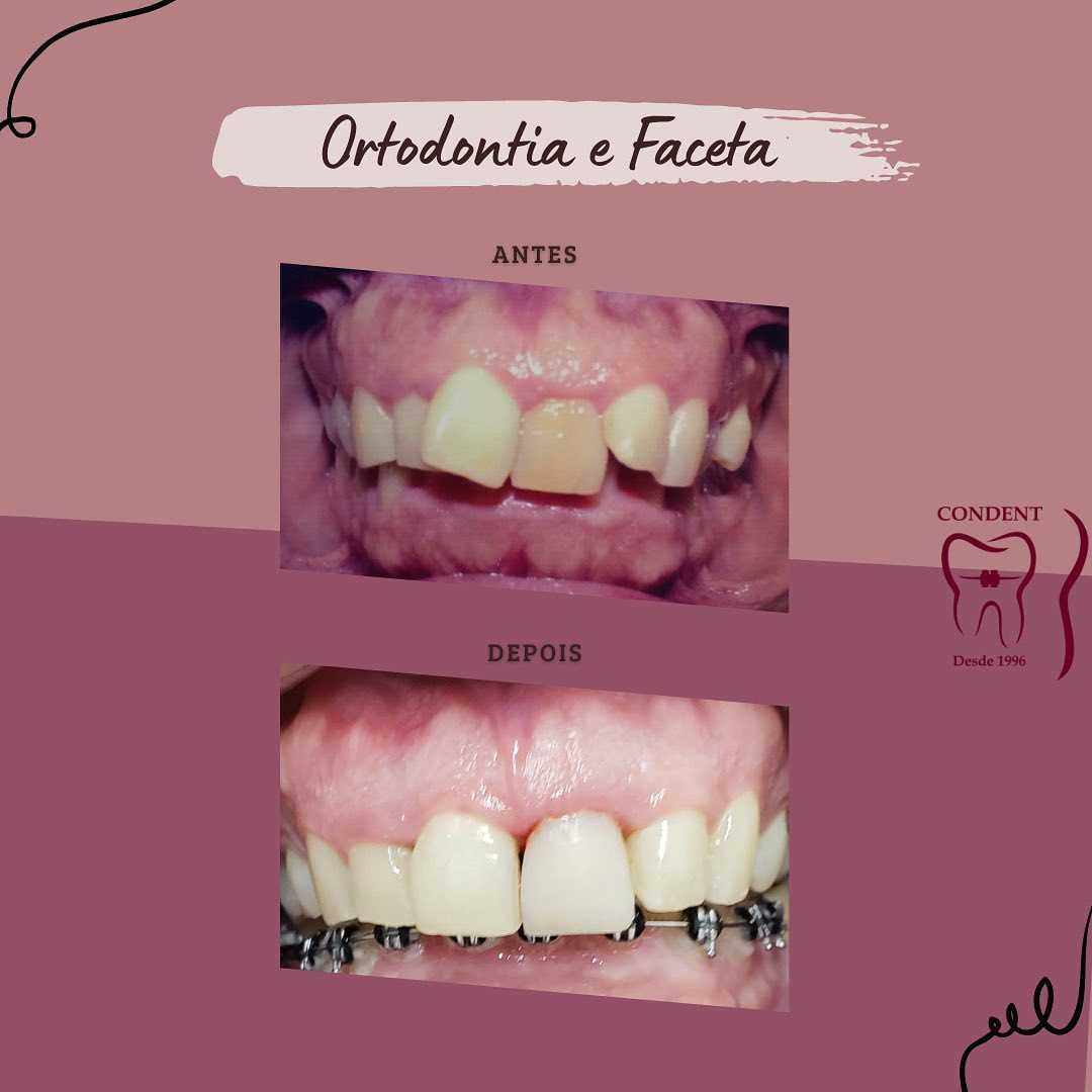 Condent - 🦷 Antes e depois de um resultado aonde unimos a...