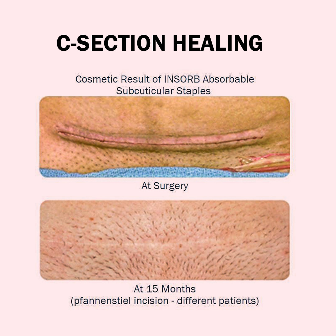 🤱 C-Section Scar Care Tips ... - Pregnancy & Parenting | Facebook