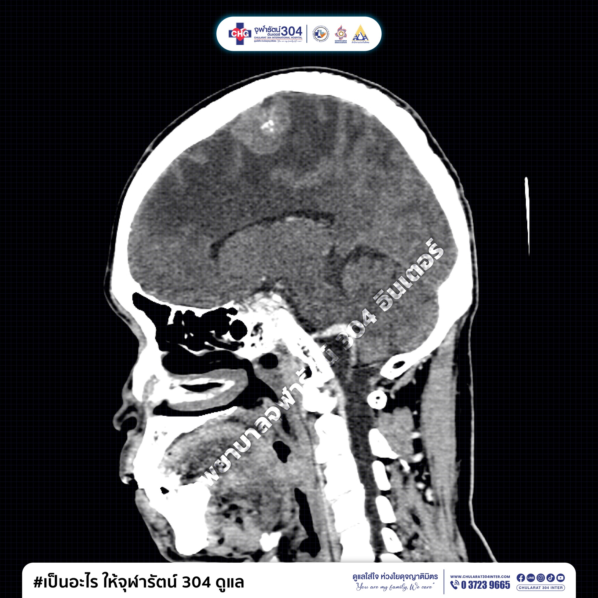 โรงพยาบาลจุฬารัตน์ - จากรูป CT-Brain ภาพนี้ #คุณคิดว่า #ตรงไหน #ผิดปกติ ...