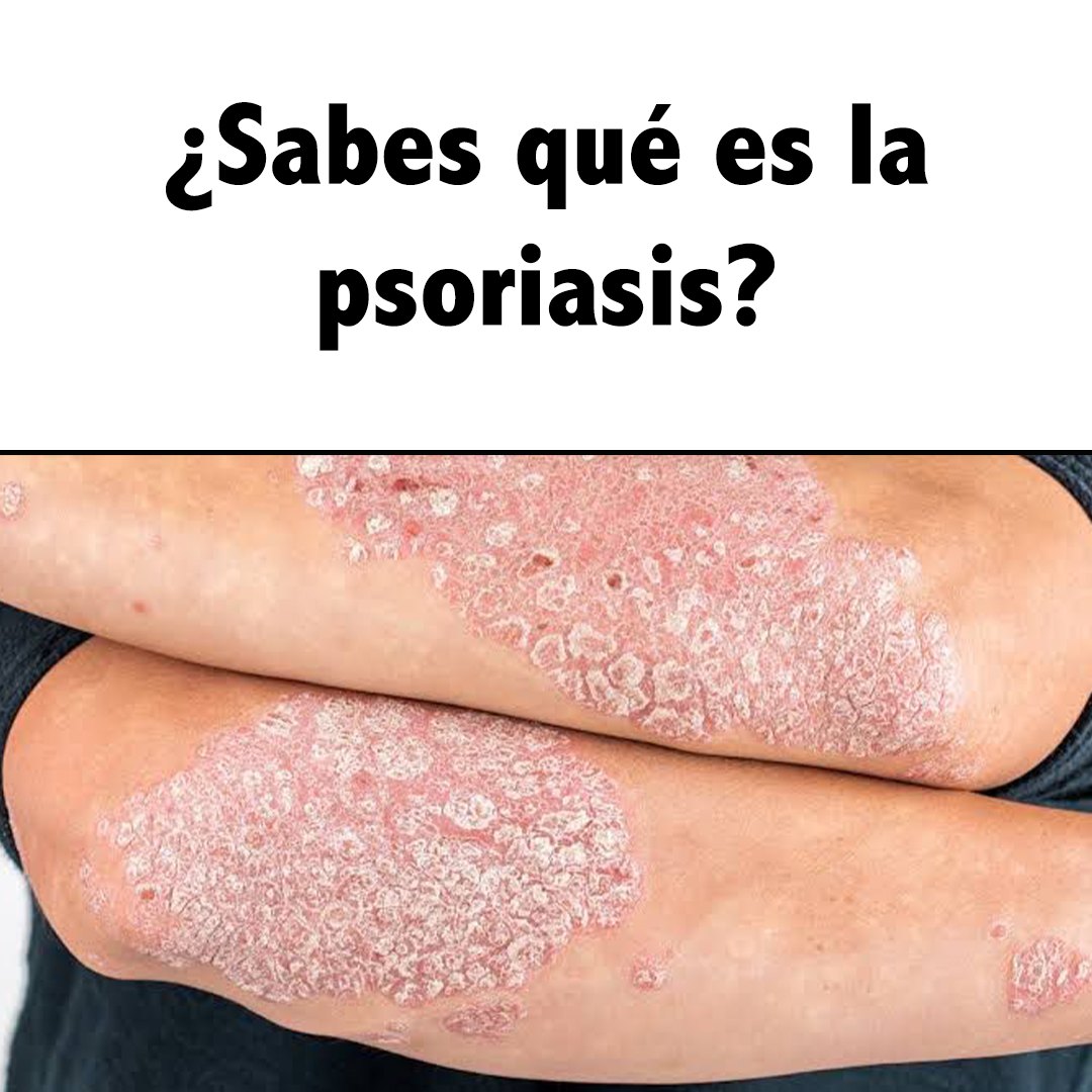 Dra. - ¿Sabes qué es la psoriasis?⬇️🤔 La psoriasis es una enfermedad de ...