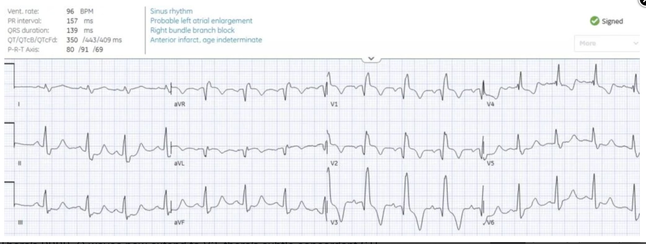 Dr. - Chest pain with acute RBBB: just another NSTEMI? https ...