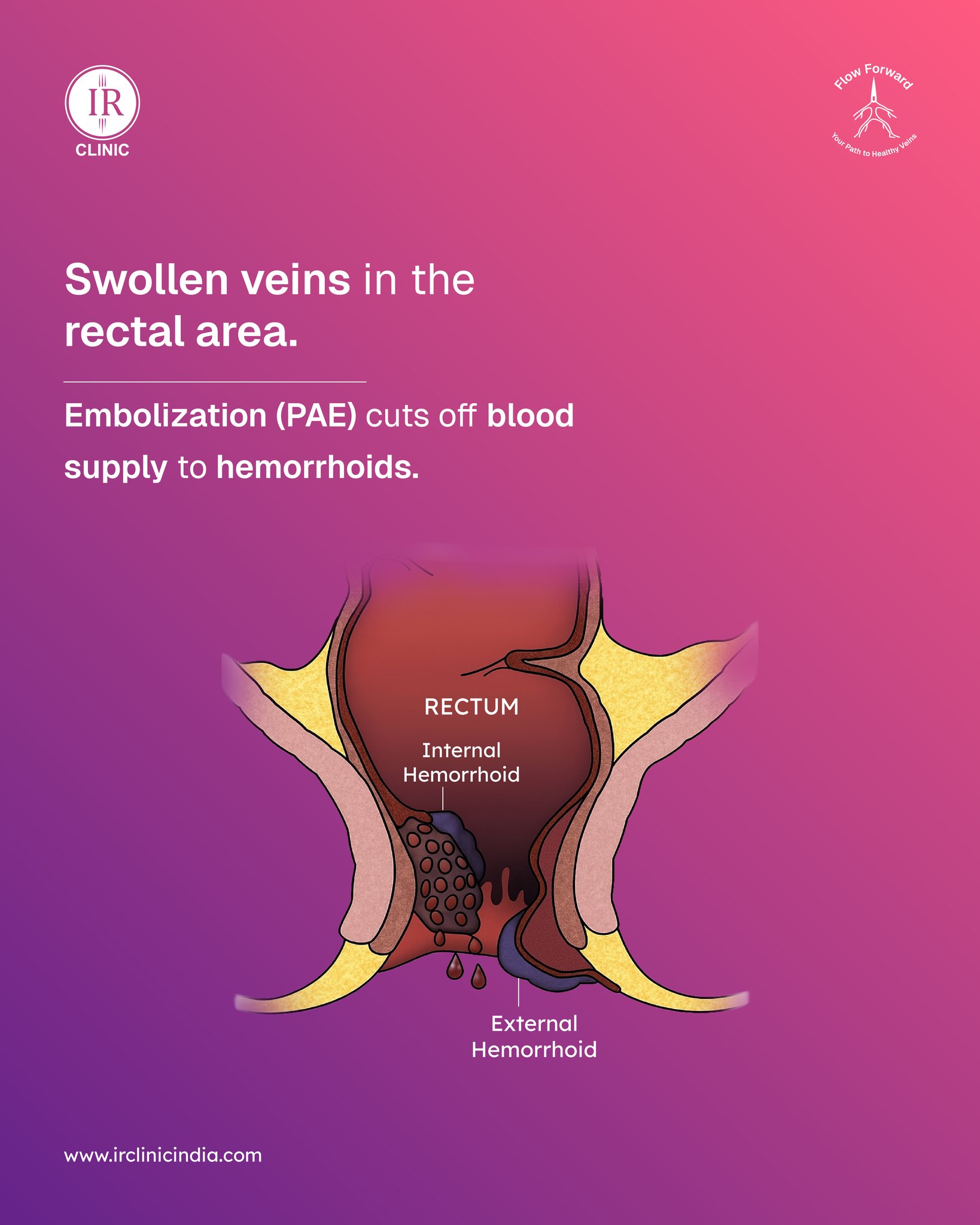 IR - Swollen veins in the rectal area (hemorrhoids) can cause chronic ...