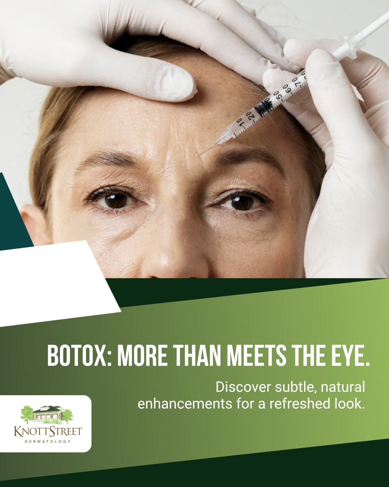 Knott - 🌟 The Art of Subtle Rejuvenation with Botox! 💉 While famously ...