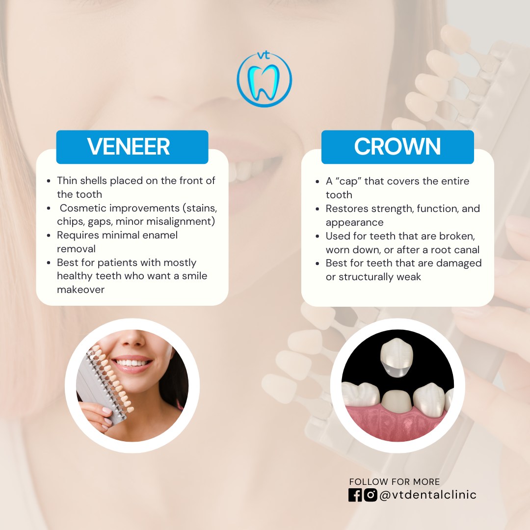 🤔 Veneers or Crowns — which one is... - VT Dental Clinic | Facebook