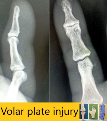 ข้อนิ้วบาดเจ็บแบบ Volar Plate Injury ของ PIP Joint คืออะไร? Volar plate ...