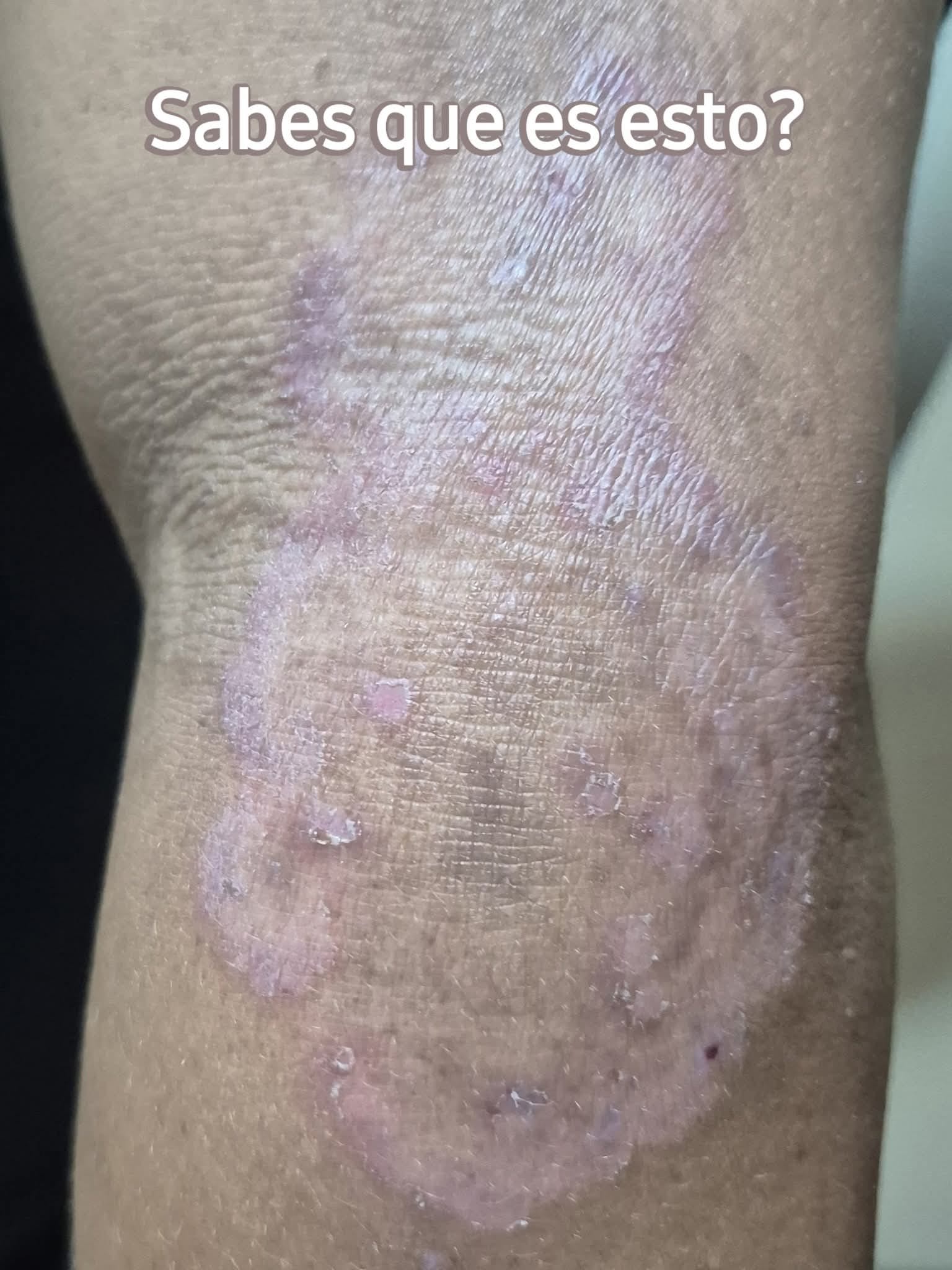Estrecho - Esta es una infección por hongos, contagiosa, provocada por ...