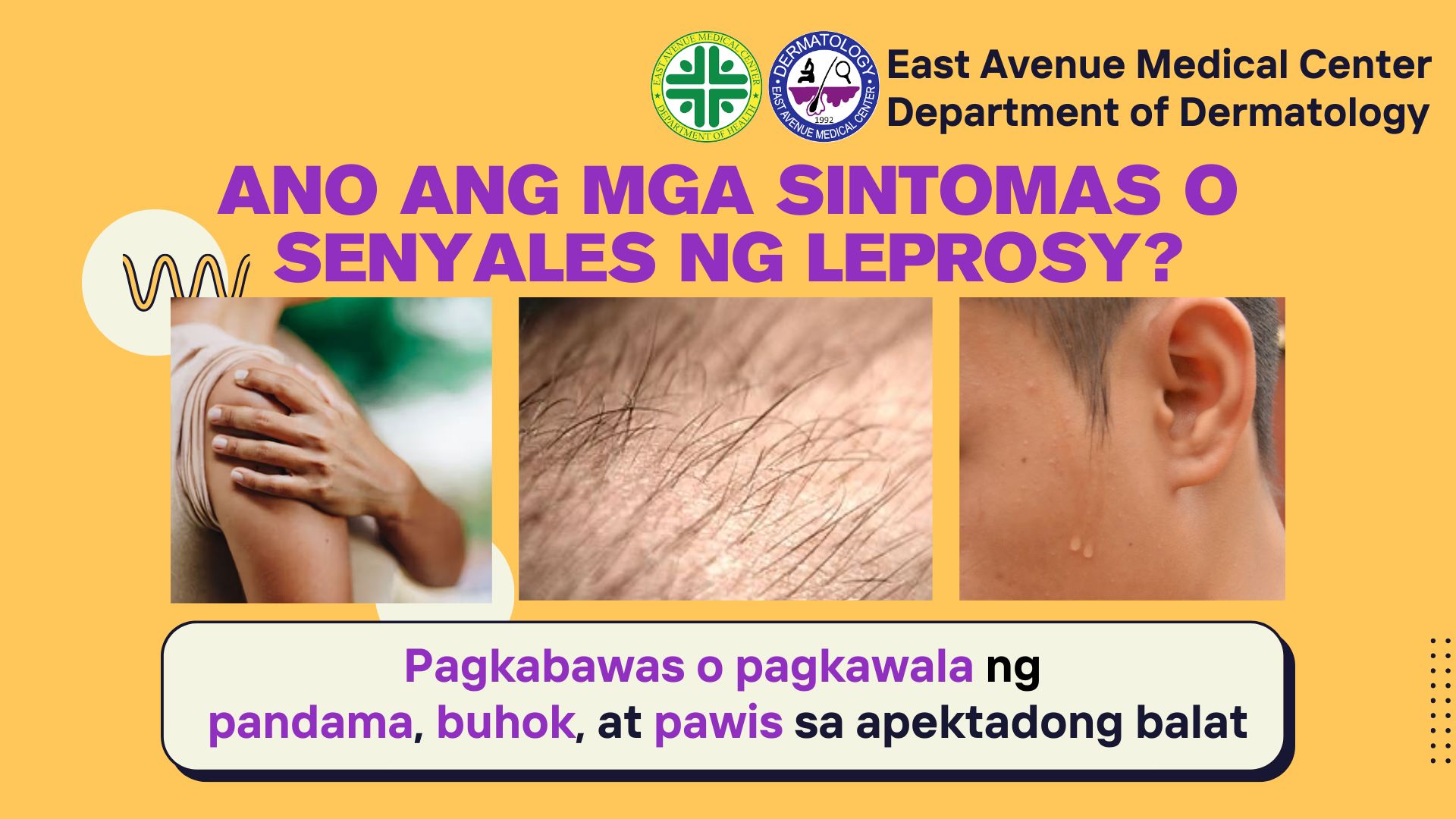 EAMC - Ang CONTACT DERMATITIS ay isang kondisyon sa balat na nagdudulot ...