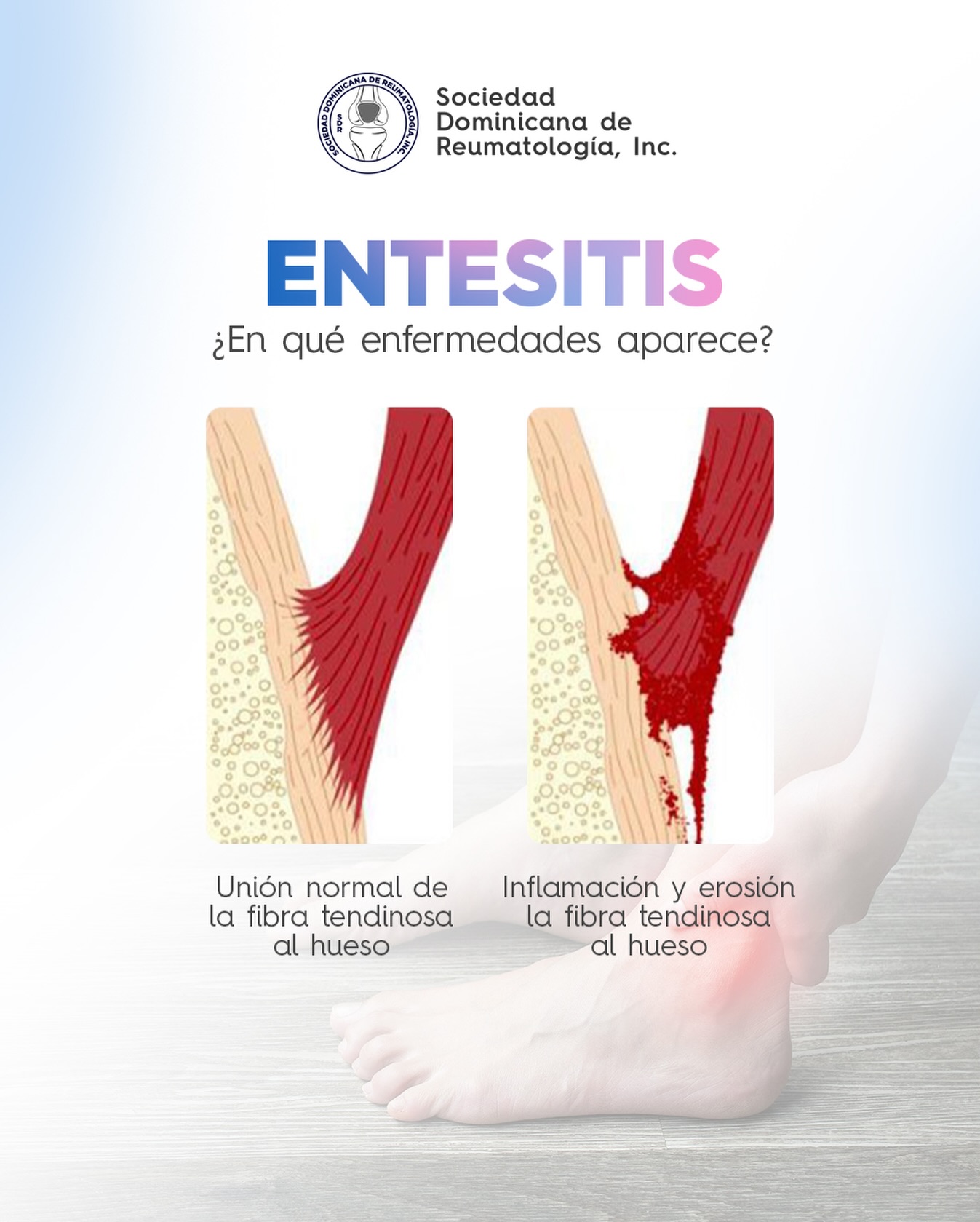 Sociedad - La entesitis es la inflamación de las entesis, que son los ...