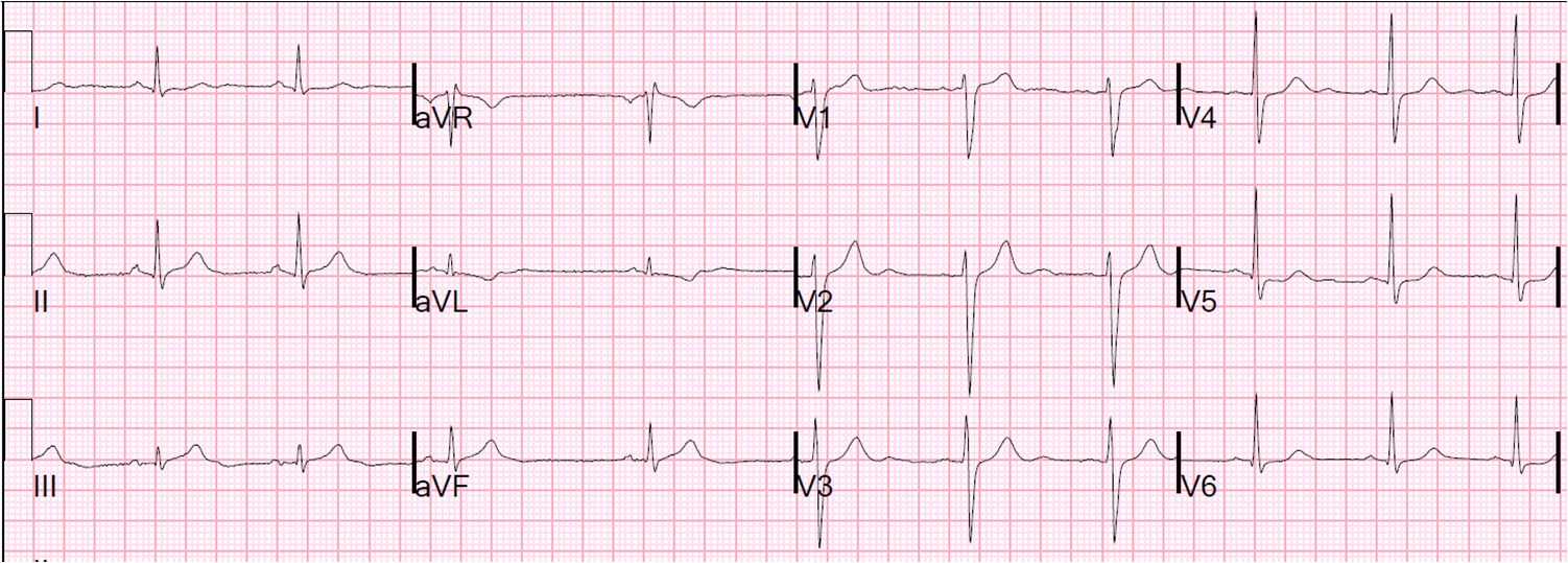 Dr. Smith's ECG Blog - Deepening T-wave inversion one week after STEMI ...