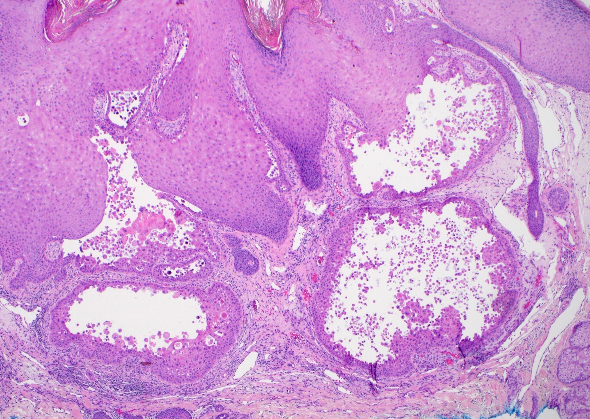 Jerad Gardner, MD - Calcifying epithelial odontogenic (Pindborg) tumor ...
