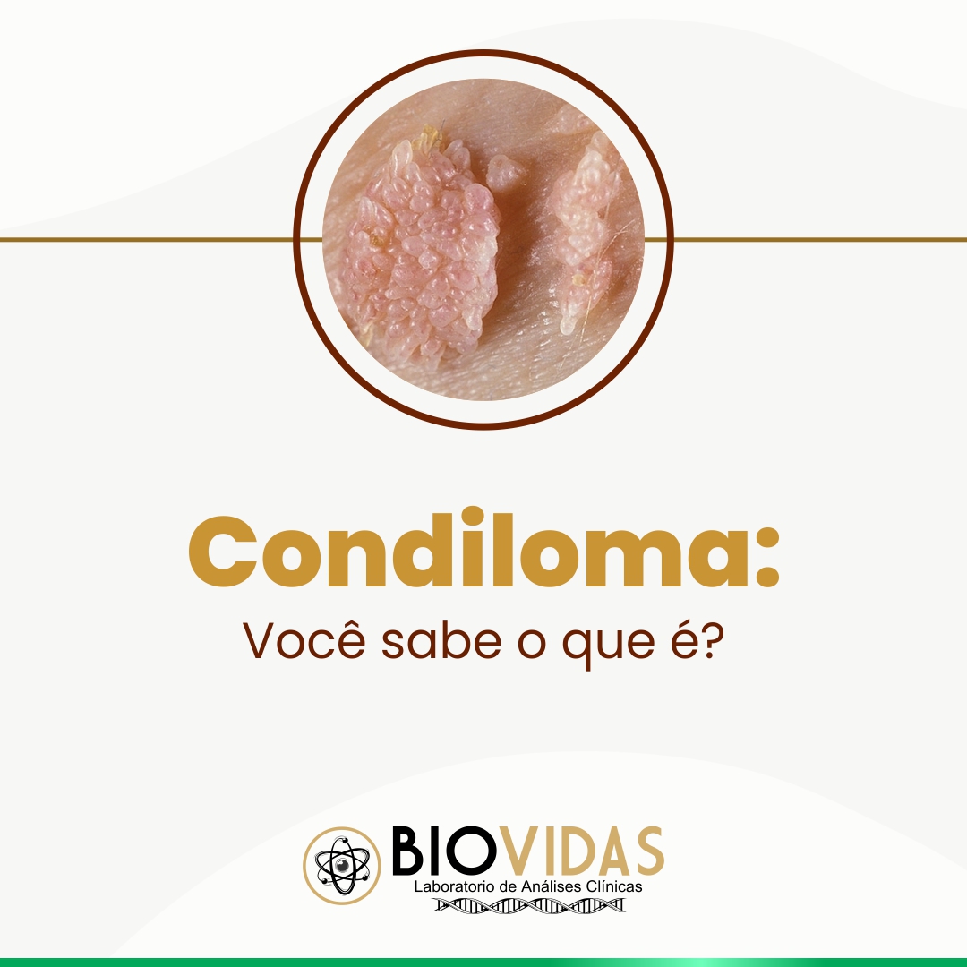 ️ Condiloma é uma infecção causada... - Laboratório Biovidas