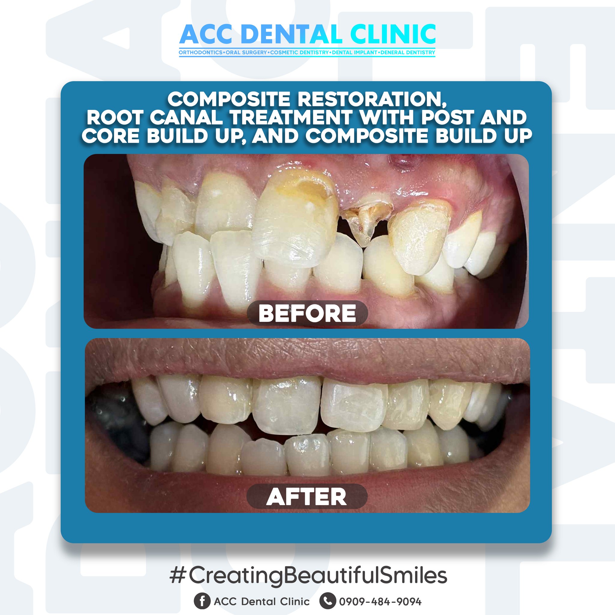 ACC - Your Smile Deserves Expert Care! ✨? Say goodbye to damaged 