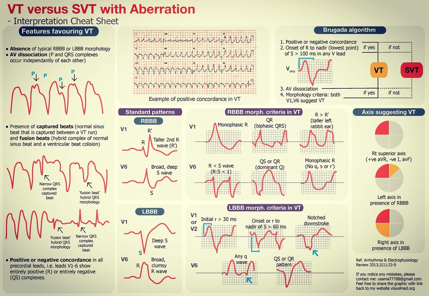 EKG Central - 🔰 VT(Ventricular Tachycardia) Vs SVT(Supraventricular ...