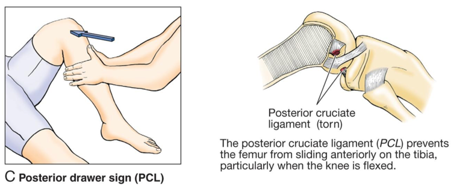 Phoenix Rehab - Posterior cruciate ligament (PCL) injury...