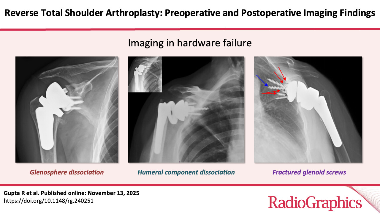 Reverse total shoulder arthroplasty is rapidly expanding and