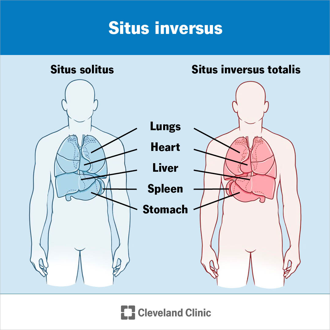 Situs inversus is a rare condition... - Cleveland Clinic | Facebook
