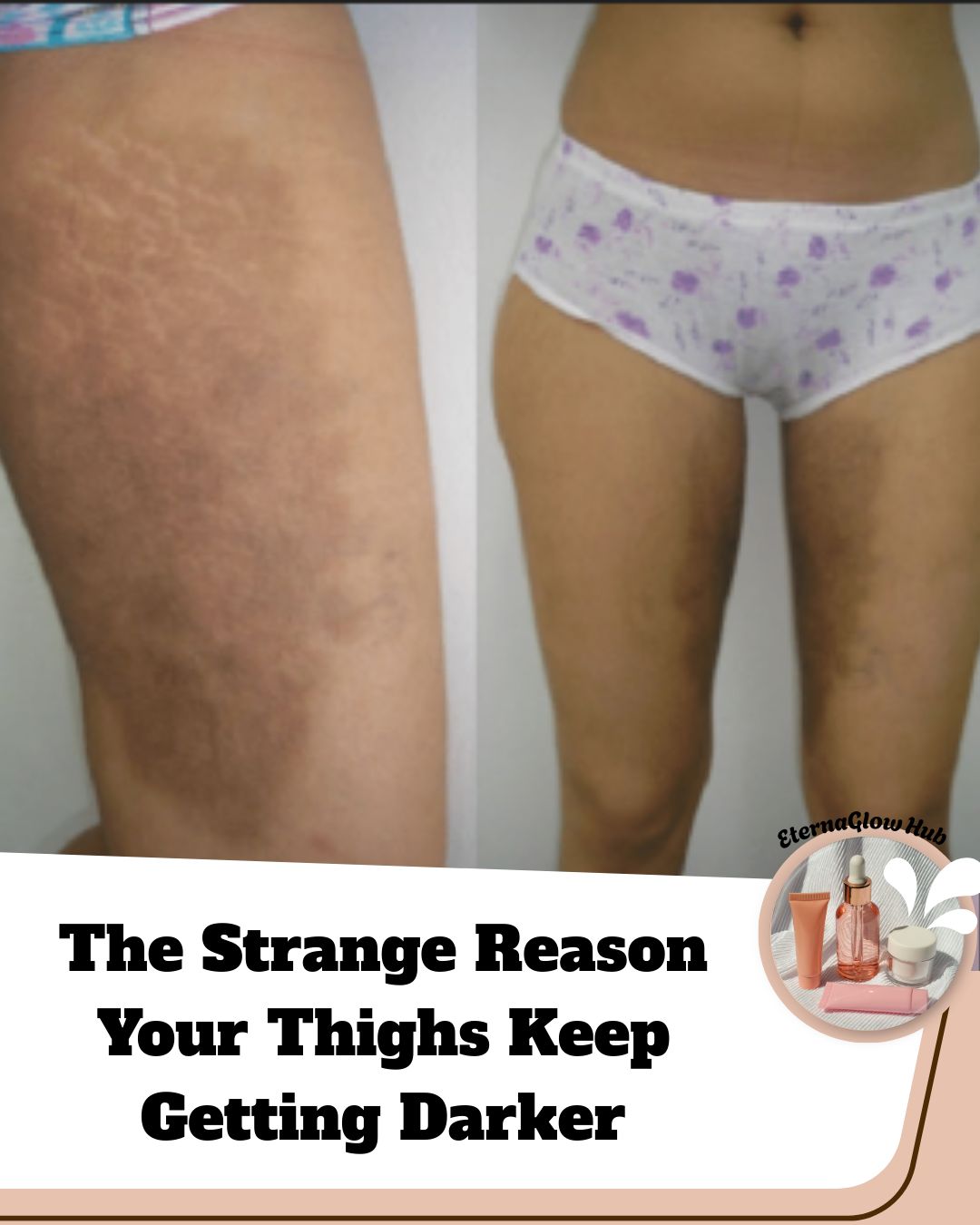 can glutathione lighten dark inner thighs Lightening with hidradenitis suppurativa and oil allergies RETATRUTIDE + CAGRILINTIDE – Select Box Quantity:6 Boxes professional body peel
