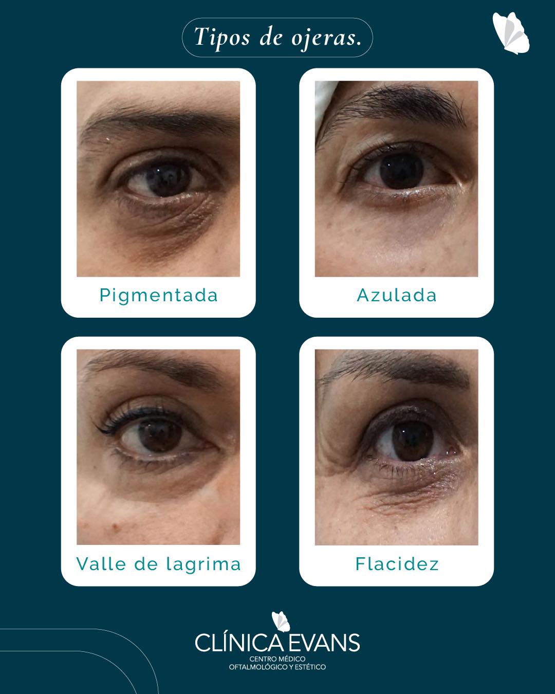 Dra. - 👁️ Tipos de Ojeras: Diagnóstico y Tratamiento 👁️ Pigmentadas ...