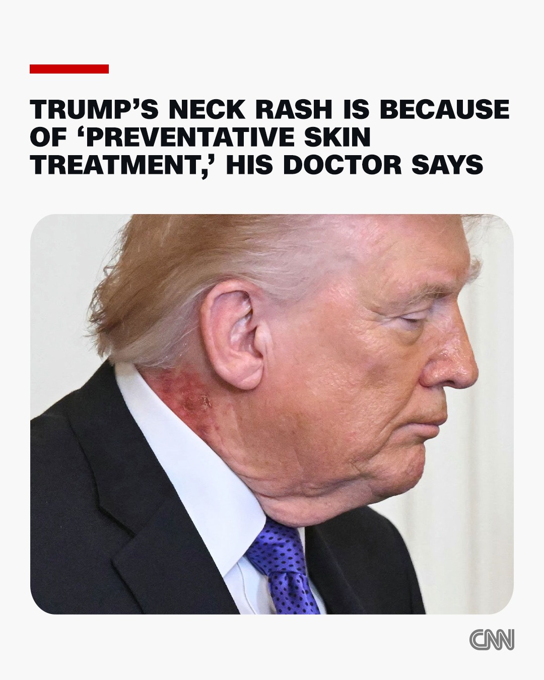 CNN - A new rash on the right side of President Donald... | Facebook