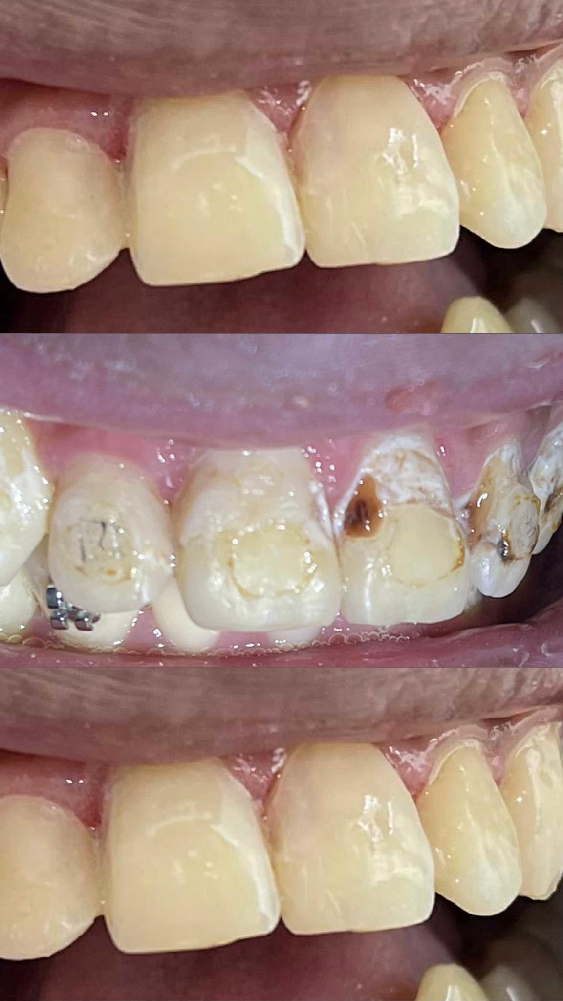 GENEROSE - 🦷 What is Dental Restoration? Dental restoration is the ...
