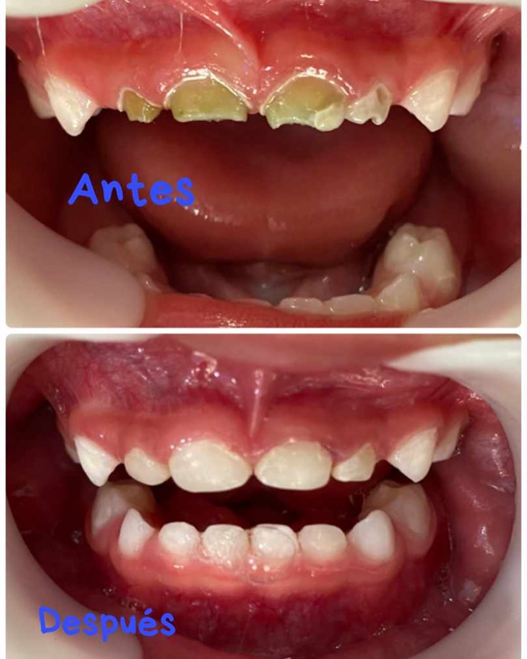 Odontobb Bebe De 2 Anos De Edad Con Caries Hace Unos Dias Acudio A Odontobb Este Bebe Sus Padres Me Dijeron Que Quieren Que Su Bebe Sea Feliz En Navidad