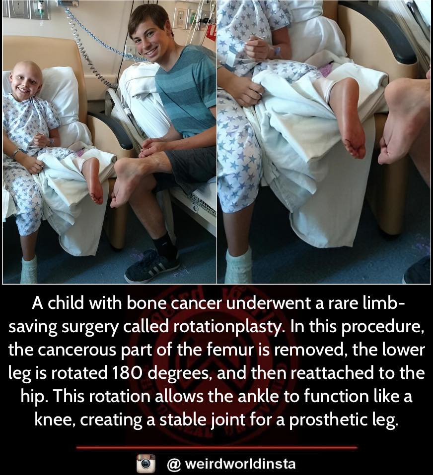 Weird - Child cancer patient underwent an unusual surgery to ...