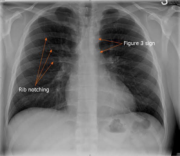 Cardiophilia - Rib notching (Roesler sign) is seen in: A... | Facebook