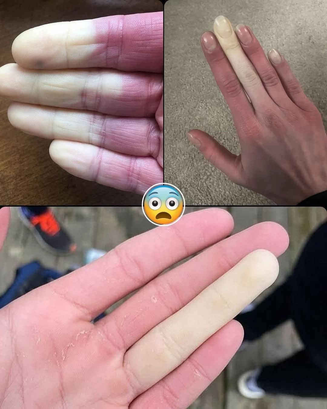 Natalia Nevin - 🧊🖐 The Raynaud phenomenon is a cond... See... | Facebook