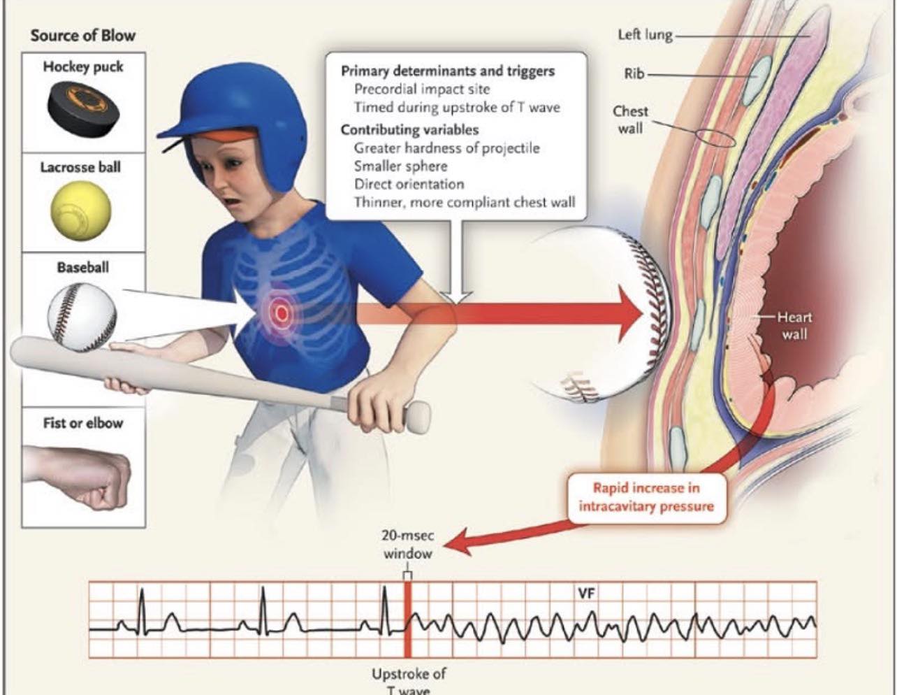 Paramedics on Facebook Group | Commotio cordis is a rare but ...