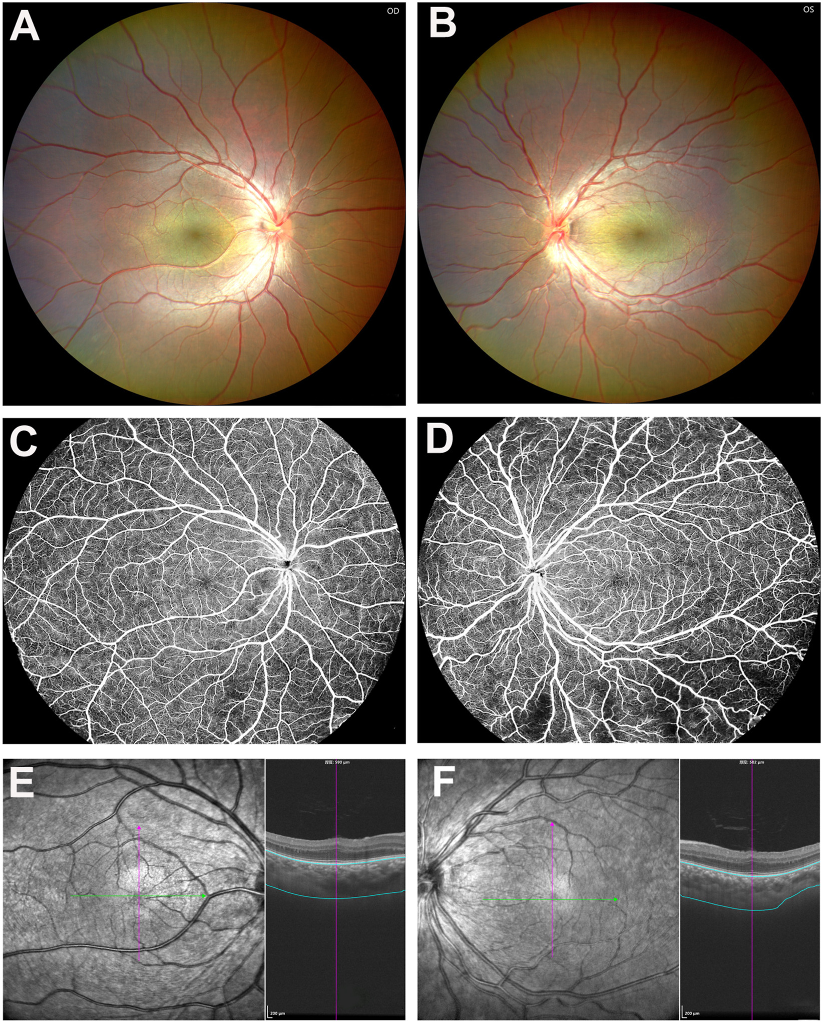 American - A 7-year-old girl with microphthalmos presented with high ...
